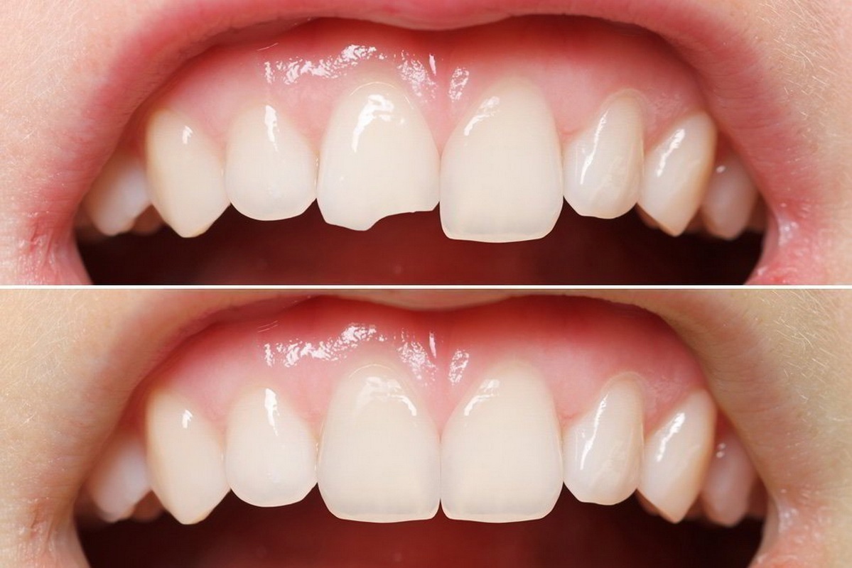 Реставрация зубов - это процесс восстановления. Стоматология Псков.