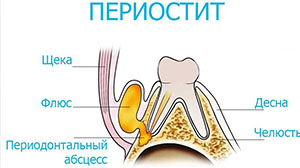 Лечение периостита челюсти Псков