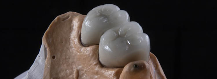 Циркониевые зубные коронки в Пскове