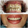 Реставрация зубов в Пскове