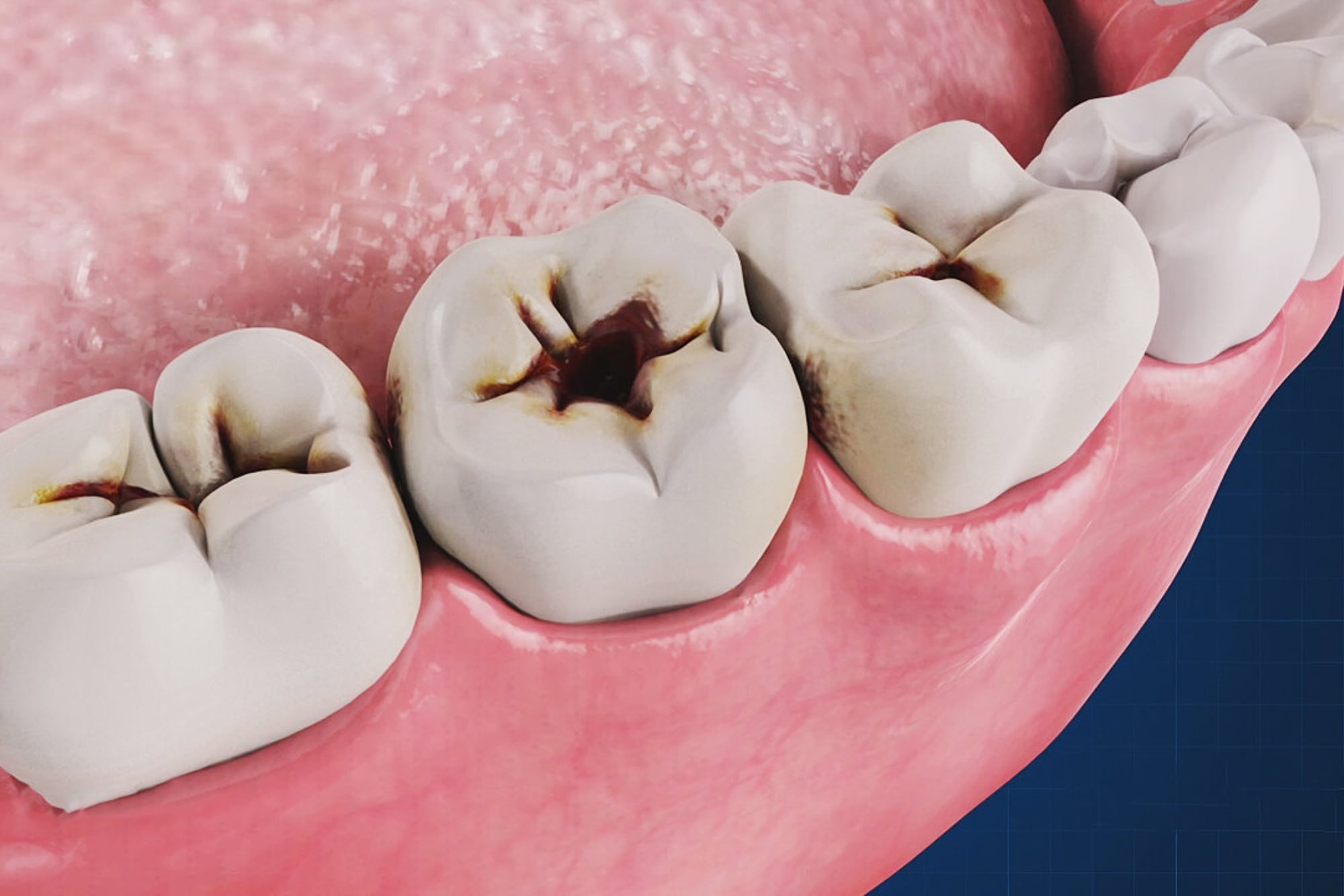 Особенности лечения зубов в Пскове